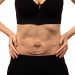 10 Best Tips on How to Tighten Loose Belly Skin