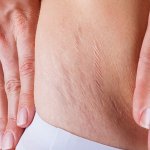 What Causes Cellulite in Men and How to Fix It