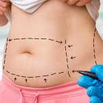 7 Effects of Weight Gain After Tummy Tuck (How to Avoid It)