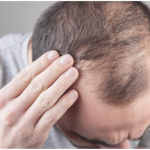 Hair Loss