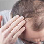 RU58841 Side Effects 1