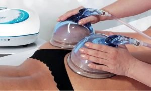 10 Surprising Vacuum Therapy Buttocks Side Effects 4 positive vacuum therepy buttocks side effects