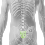 Axonics nerve stimulation device implanted in lower back | Axonics side effects