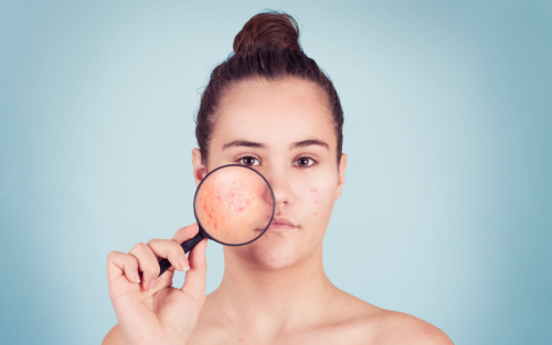 Blog 24 Side effects of Seysara on skin and health | Seysara side effects