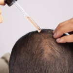 A man in Columbus applying foam to his scalp while researching minoxidil side effects and hair follicle stimulation.