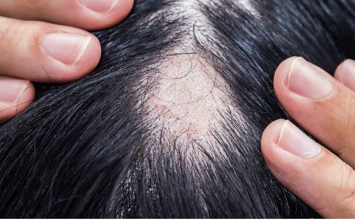 10 Dangerous Minoxidil Side Effects You Should Know 2 10 Dangerous Minoxidil Side Effects & Safety Guide | Flab Fix