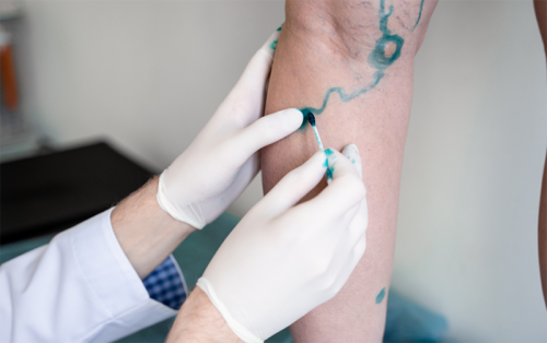 Blog 102 Vein doctor